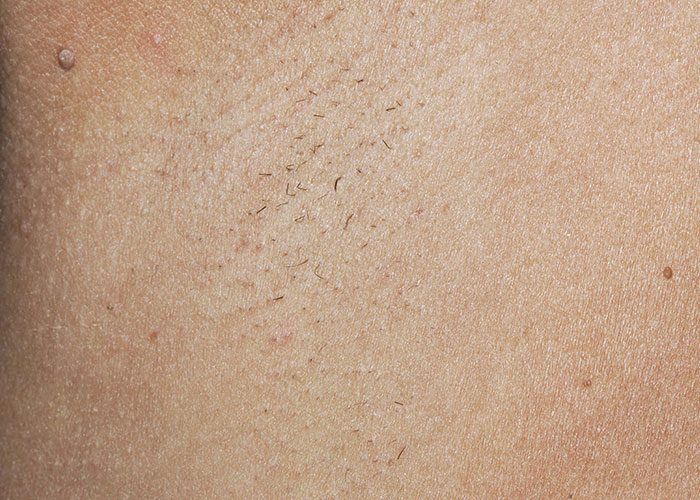 After treatment - 5–8 Weeks