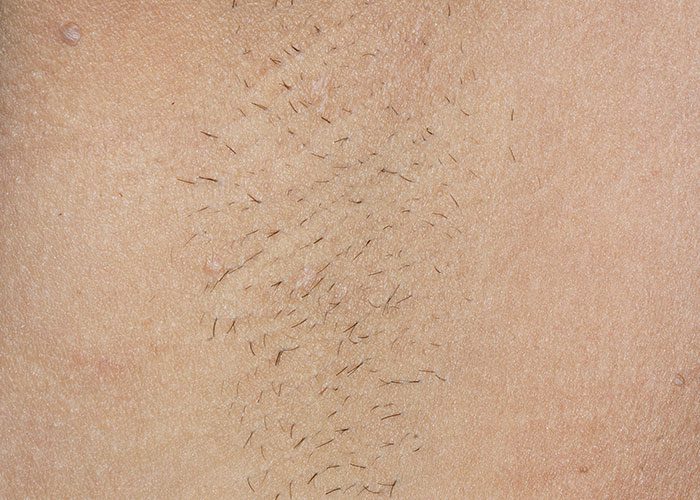 Before treatment - 5–8 Weeks