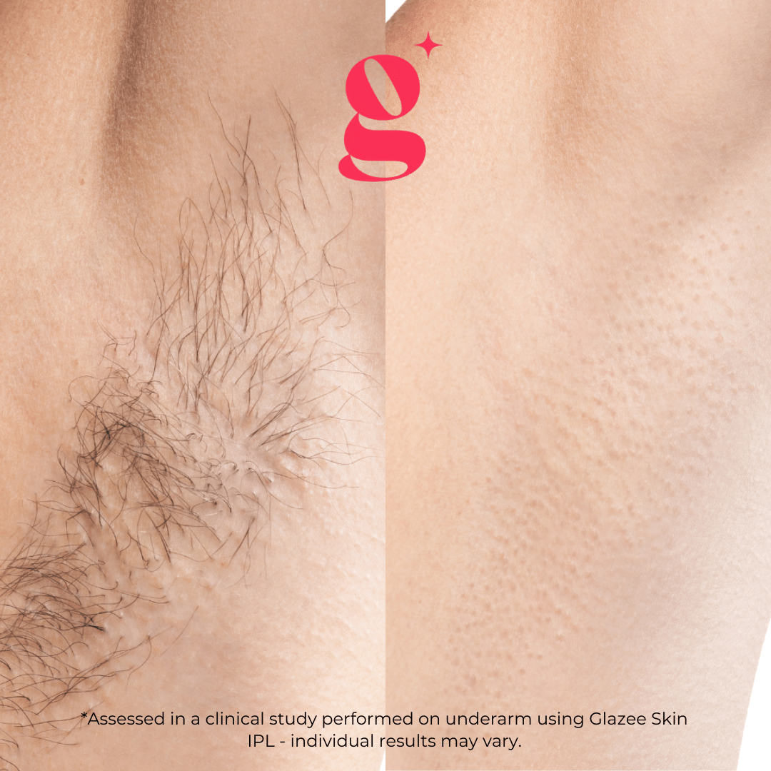 Glazee Skin Gen1 IPL Hair Removal - glazee skin