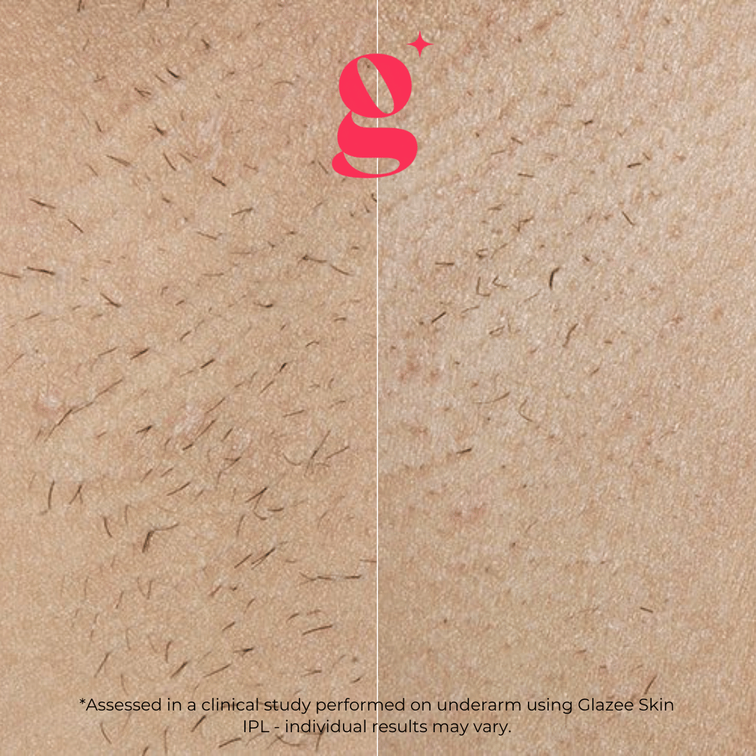 Glazee Skin Gen1 IPL Hair Removal - glazee skin