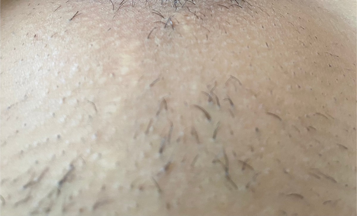 After treatment - 2–4 Weeks