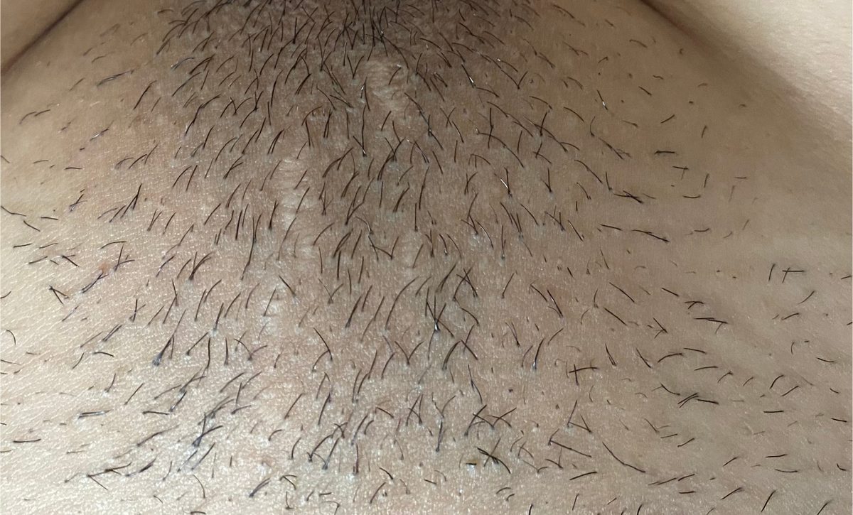 Before treatment - 2–4 Weeks