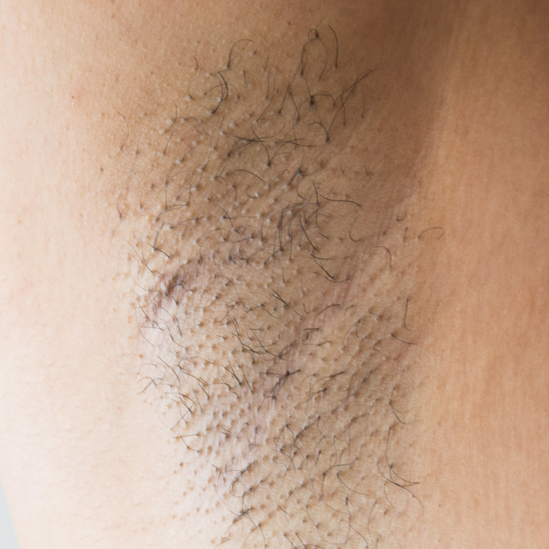 Before treatment - 8–12+ Weeks