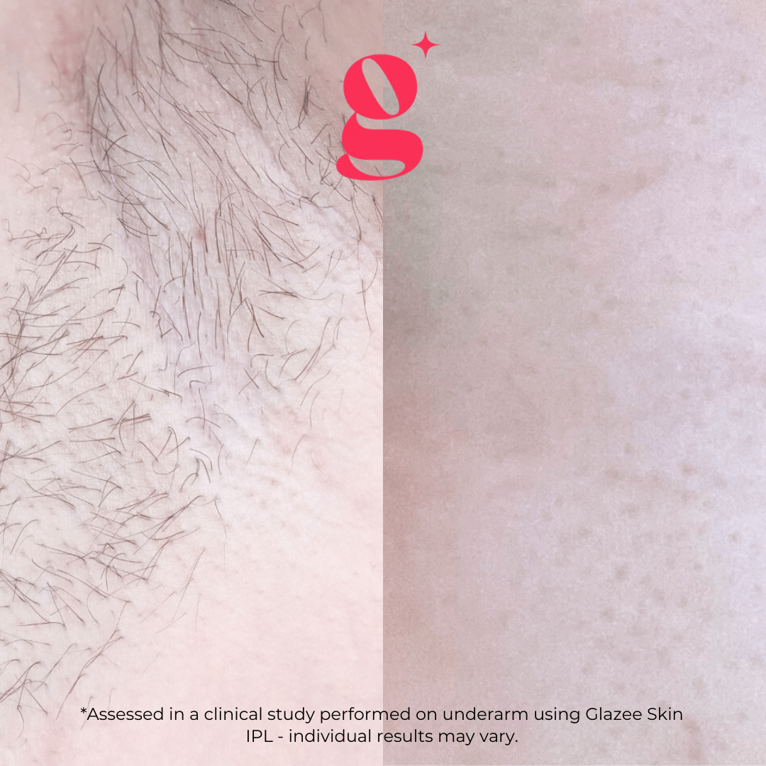 Glazee Skin Gen1 IPL Hair Removal - glazee skin