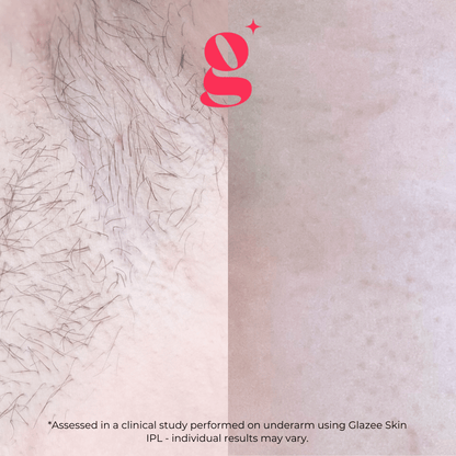 Glazee Skin Gen1 IPL Hair Removal - glazee skin